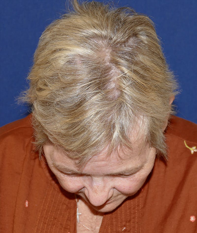 Miscellaneous Before & After Gallery - Patient 312897 - Image 4