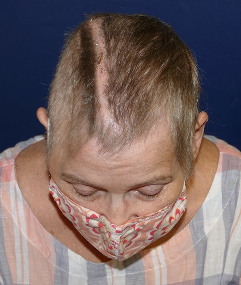 Miscellaneous Before & After Gallery - Patient 312897 - Image 3