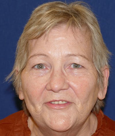 Miscellaneous Before & After Gallery - Patient 312897 - Image 2