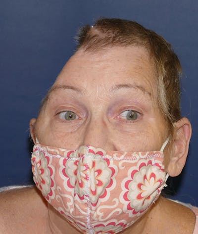 Miscellaneous Before & After Gallery - Patient 312897 - Image 1