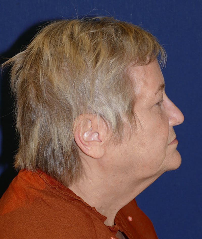 Miscellaneous Before & After Gallery - Patient 312897 - Image 6