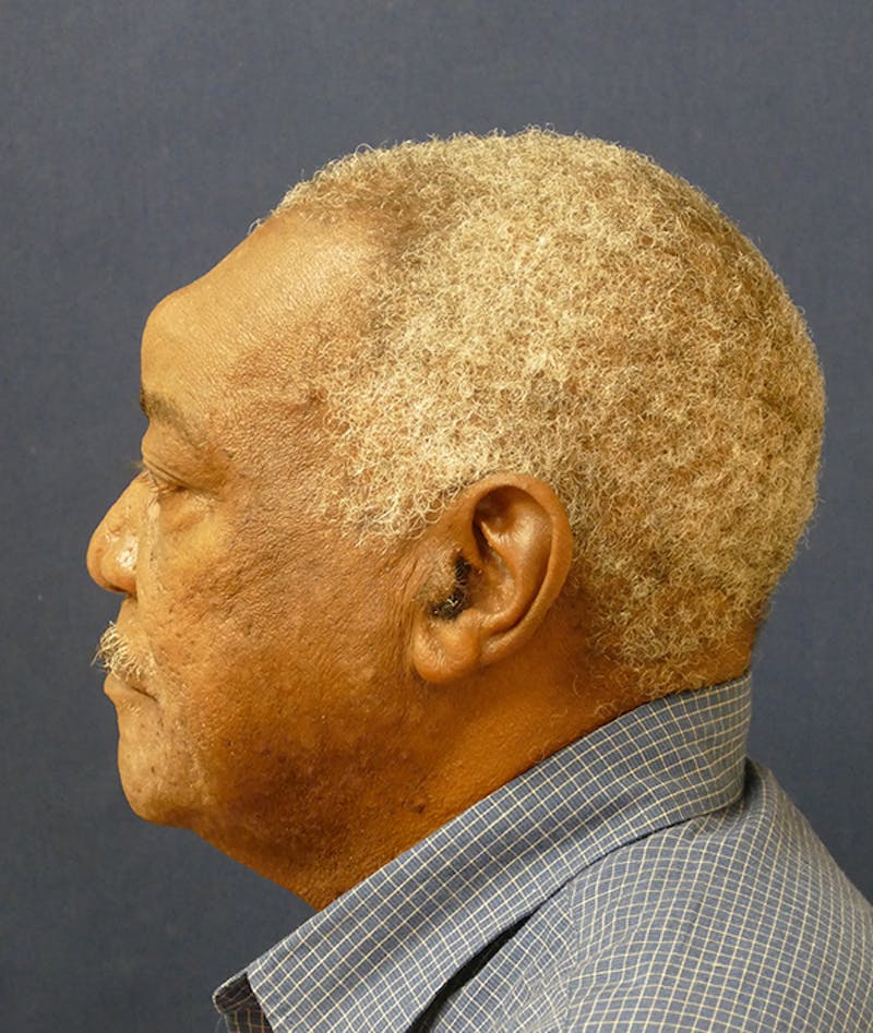 Miscellaneous Before & After Gallery - Patient 855871 - Image 10