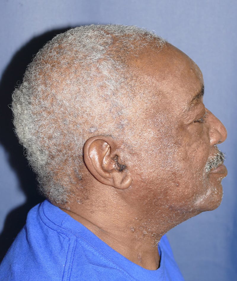 Miscellaneous Before & After Gallery - Patient 855871 - Image 9