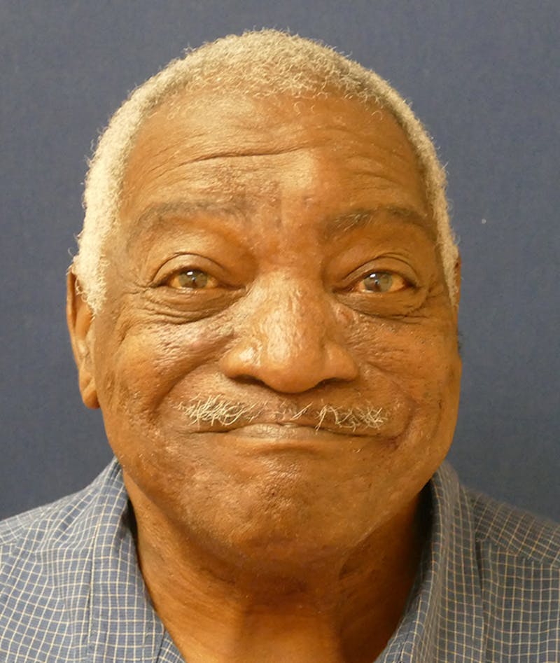 Miscellaneous Before & After Gallery - Patient 855871 - Image 3