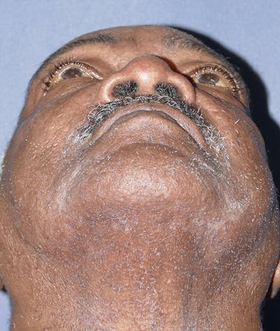 Miscellaneous Before & After Gallery - Patient 855871 - Image 2