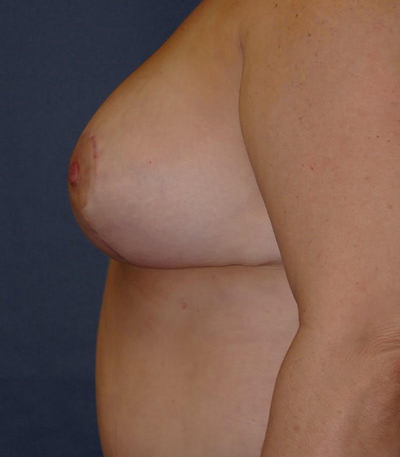 Breast Lift Before & After Gallery - Patient 356152 - Image 10