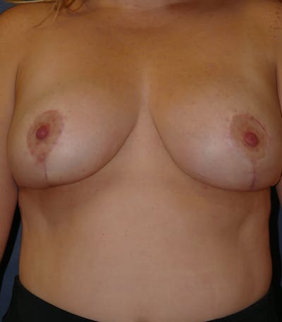 Breast Lift Before & After Gallery - Patient 356152 - Image 2