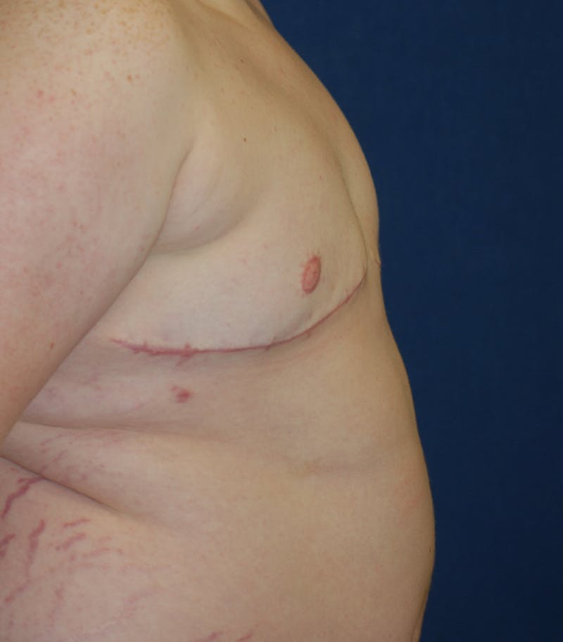 Masculinizing Surgery Before & After Gallery - Patient 313555 - Image 8