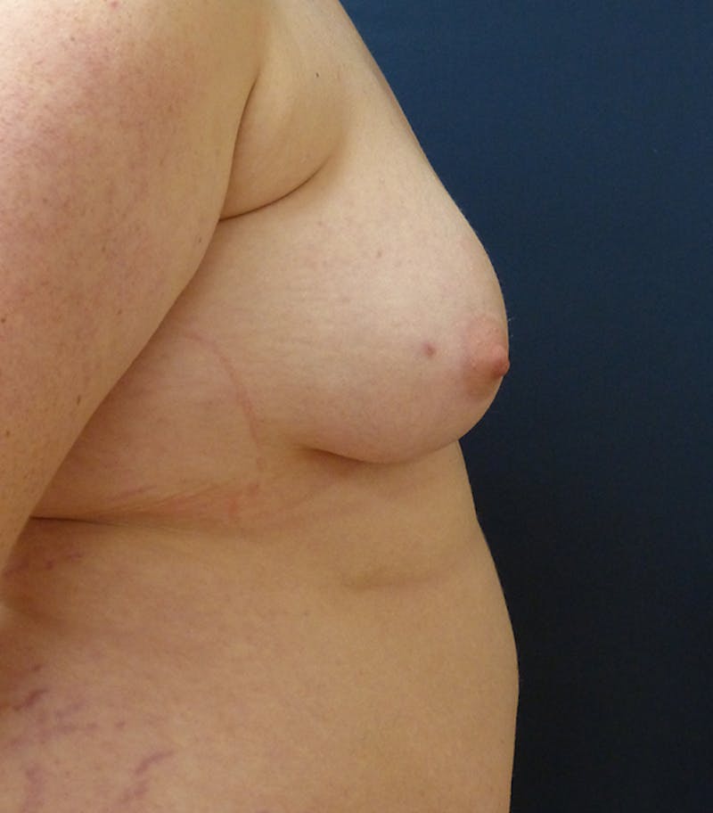 Masculinizing Surgery Before & After Gallery - Patient 313555 - Image 7