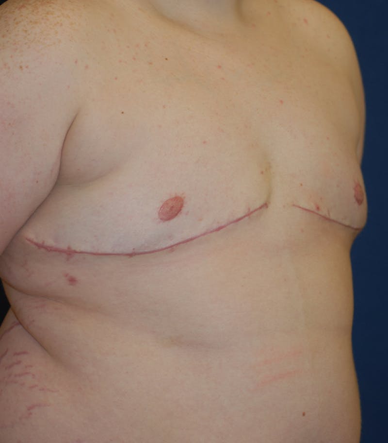 Masculinizing Surgery Before & After Gallery - Patient 313555 - Image 6