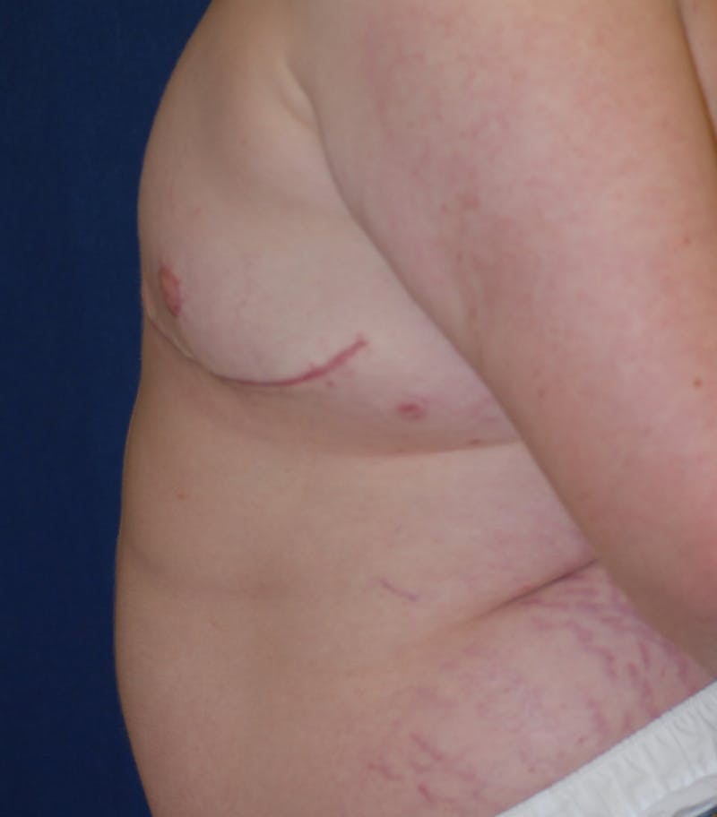 Masculinizing Surgery Before & After Gallery - Patient 313555 - Image 4