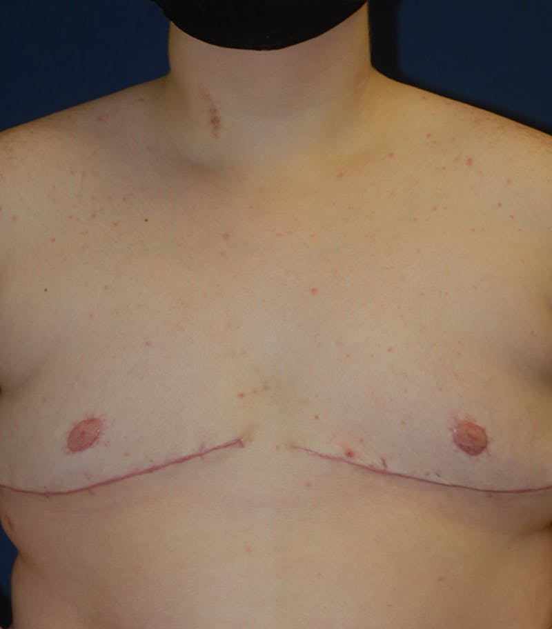 Masculinizing Surgery Before & After Gallery - Patient 313555 - Image 2