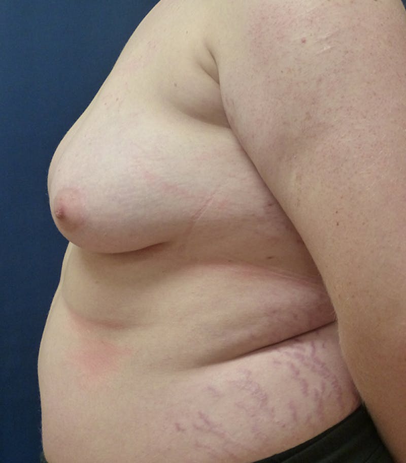 Masculinizing Surgery Before & After Gallery - Patient 313555 - Image 3