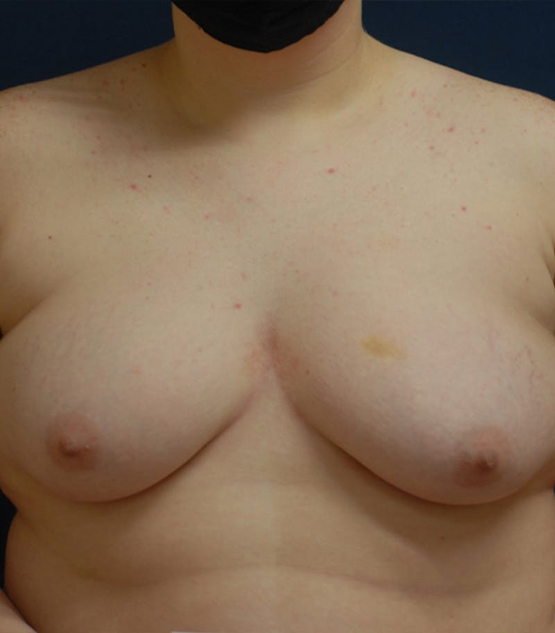 Masculinizing Surgery Before & After Gallery - Patient 313555 - Image 1
