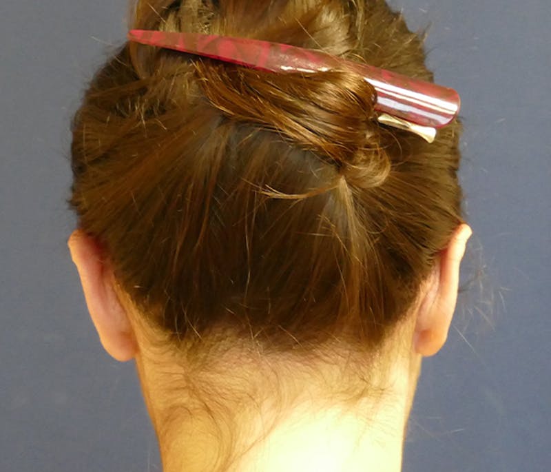 Ear Pinning (Otoplasty) Before & After Gallery - Patient 447352 - Image 4