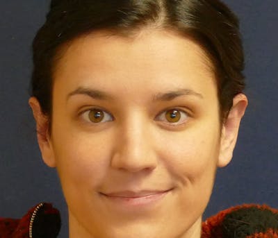 Ear Pinning (Otoplasty) Before & After Gallery - Patient 447352 - Image 2
