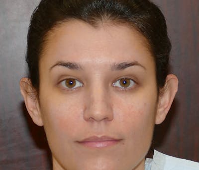 Ear Pinning (Otoplasty) Before & After Gallery - Patient 447352 - Image 1