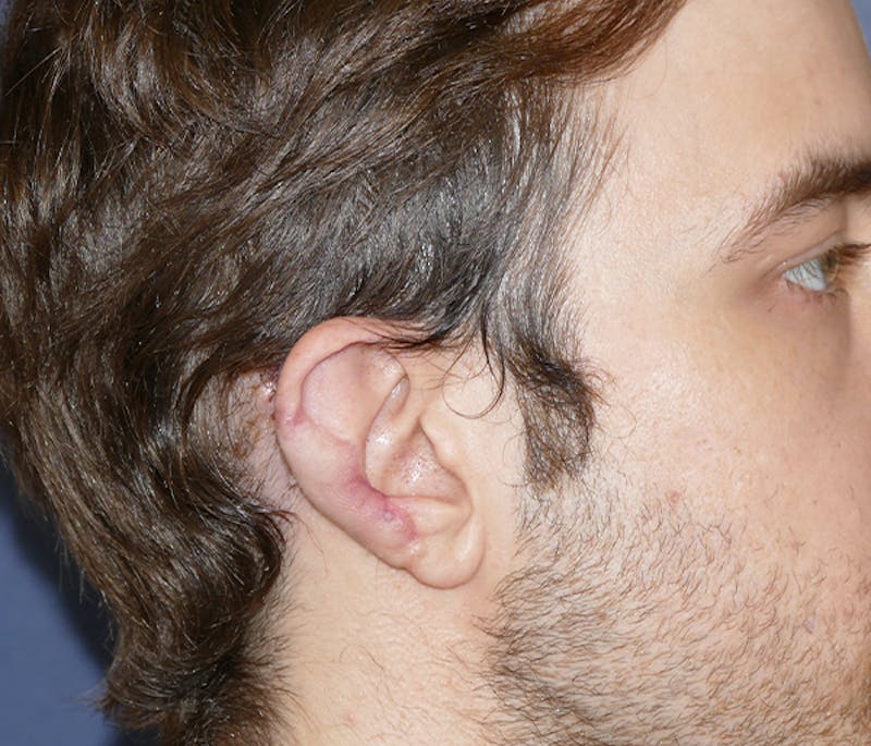 Miscellaneous Before & After Gallery - Patient 239162 - Image 5