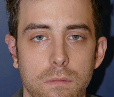 Miscellaneous Before & After Gallery - Patient 239162 - Image 1