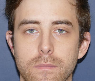 Miscellaneous Before & After Gallery - Patient 239162 - Image 2