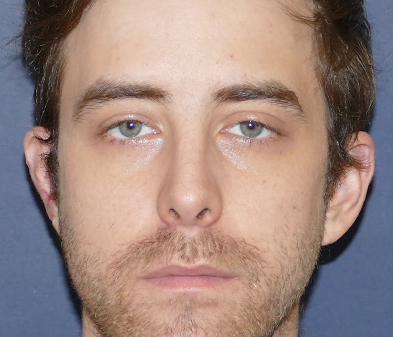 Miscellaneous Before & After Gallery - Patient 239162 - Image 2