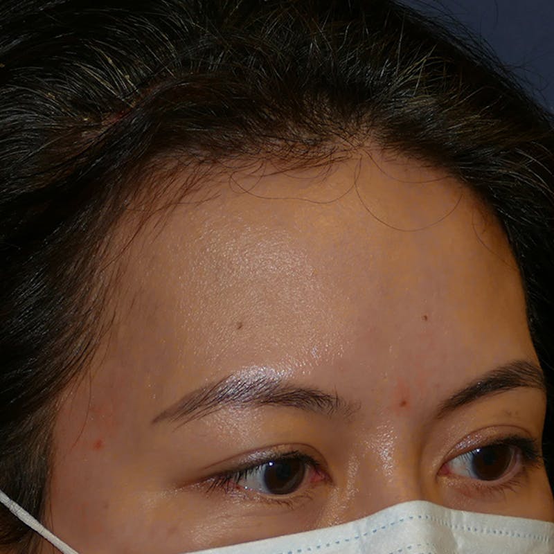 Scars/Malformations Before & After Gallery - Patient 405783 - Image 6