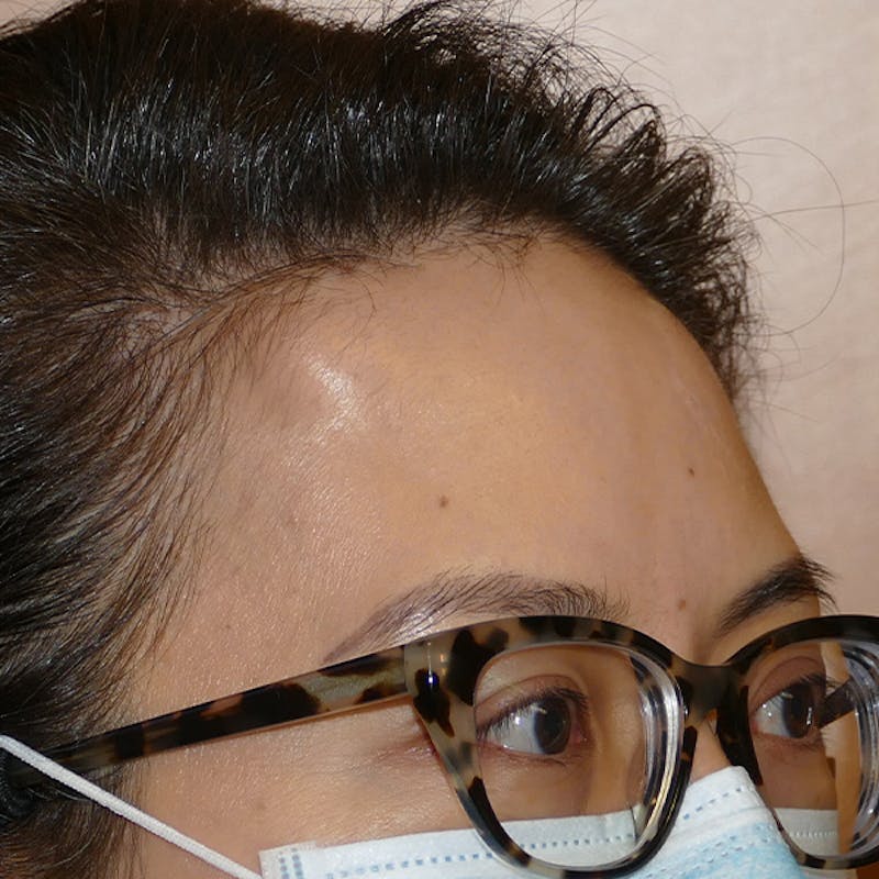 Scars/Malformations Before & After Gallery - Patient 405783 - Image 5