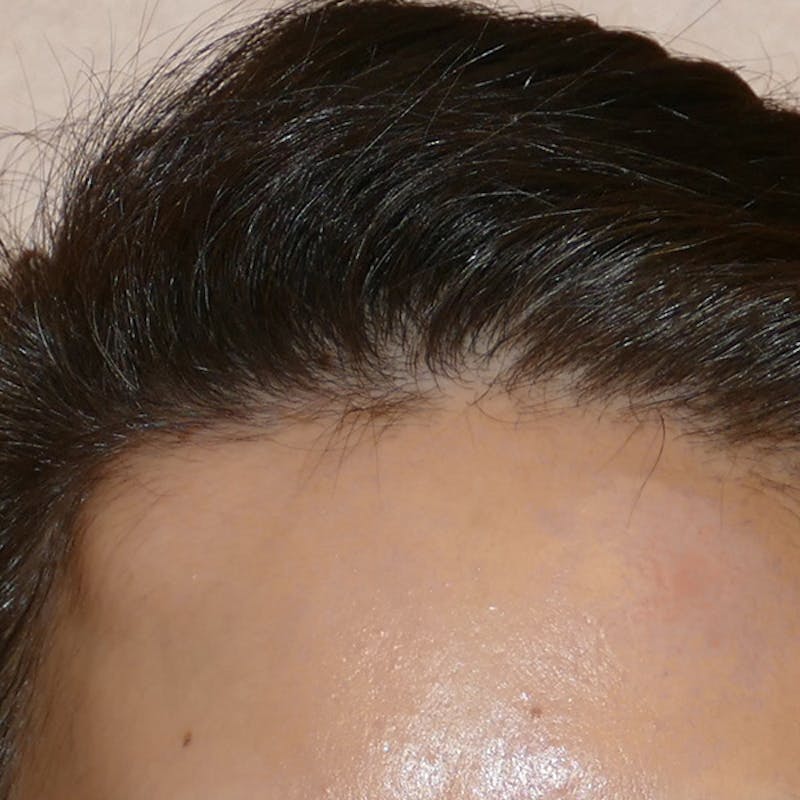 Scars/Malformations Before & After Gallery - Patient 405783 - Image 3