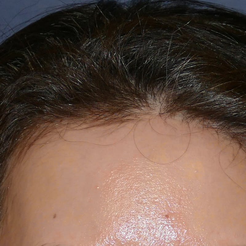 Scars/Malformations Before & After Gallery - Patient 405783 - Image 4
