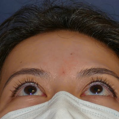 Scars/Malformations Before & After Gallery - Patient 405783 - Image 2