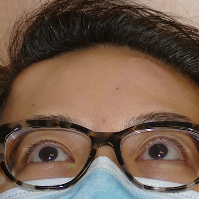 Scars/Malformations Before & After Gallery - Patient 405783 - Image 1