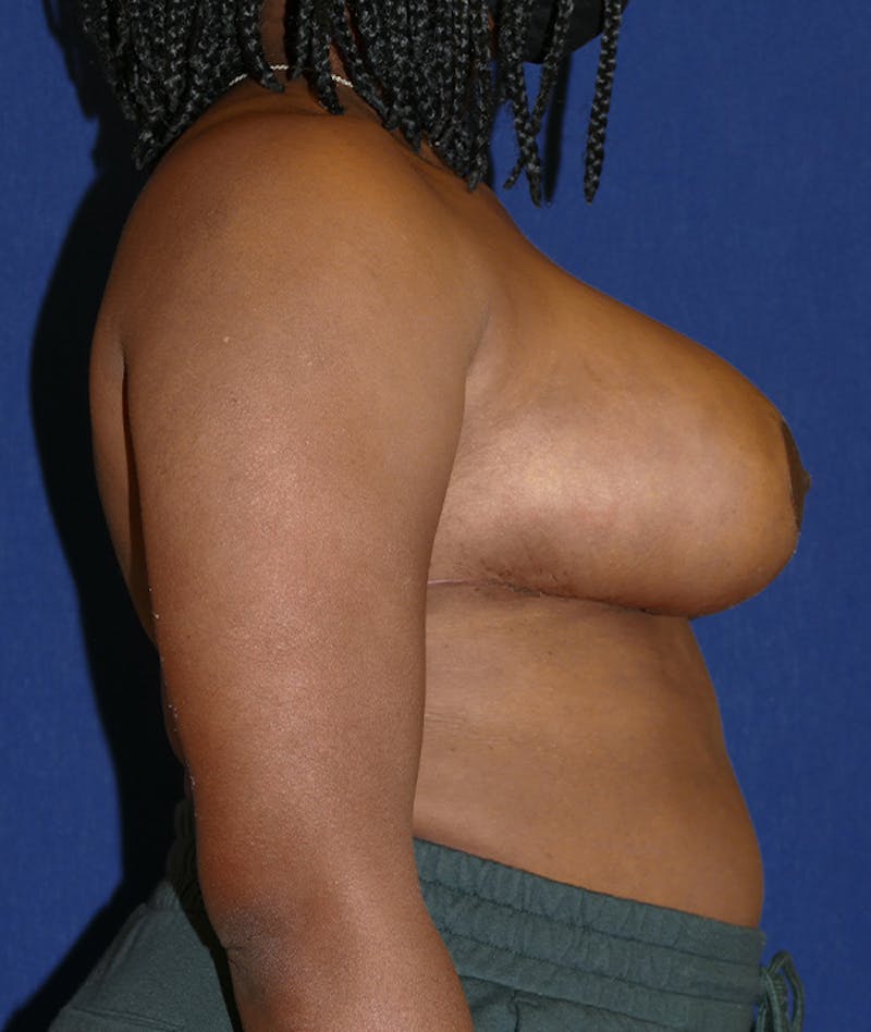 Breast Reduction Before & After Gallery - Patient 155610 - Image 10