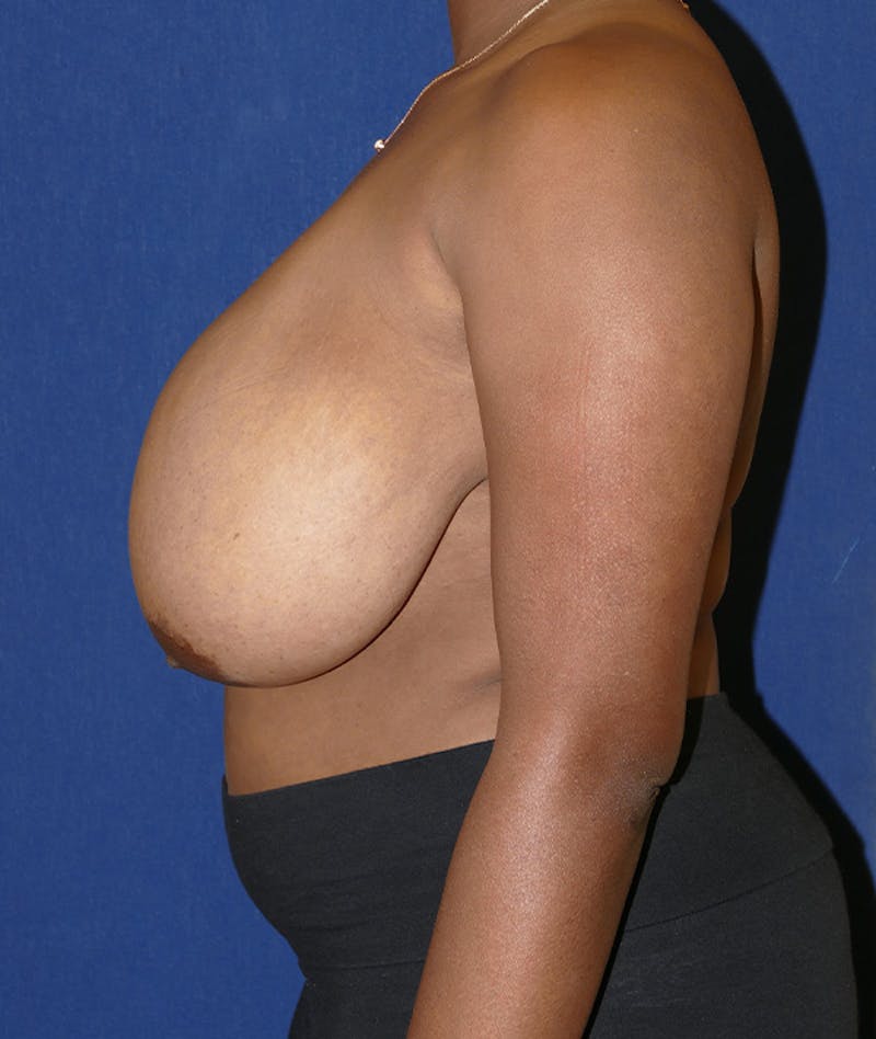 Breast Reduction Before & After Gallery - Patient 155610 - Image 5