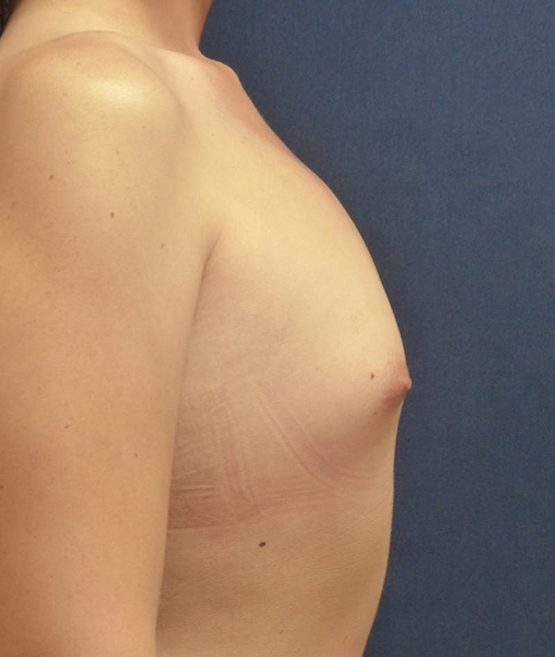Feminizing Surgery Before & After Gallery - Patient 103471 - Image 5