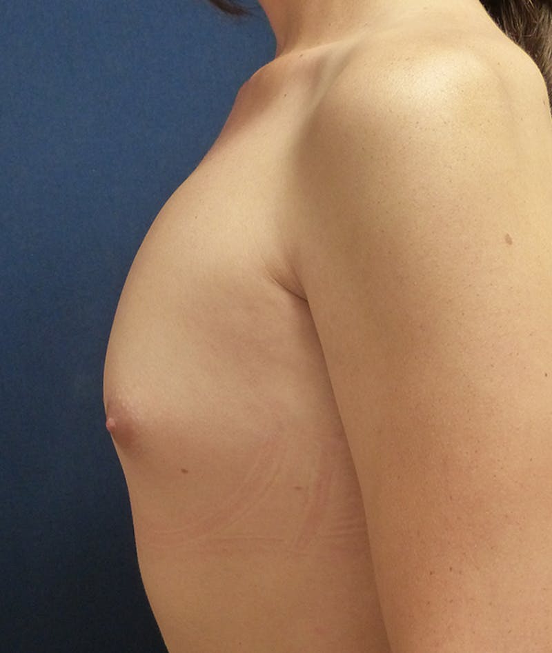 Feminizing Surgery Before & After Gallery - Patient 103471 - Image 3