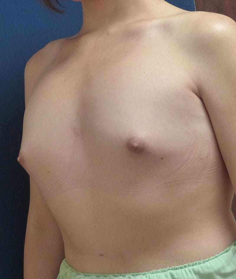 Feminizing Surgery Before & After Gallery - Patient 103471 - Image 1