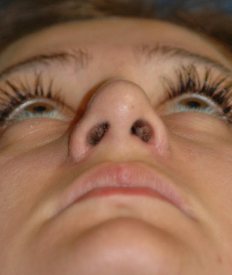 Rhinoplasty Before & After Gallery - Patient 252887 - Image 8
