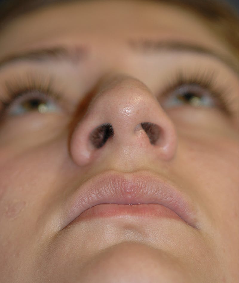 Rhinoplasty Before & After Gallery - Patient 252887 - Image 7