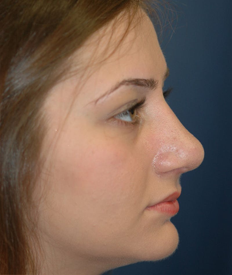 Rhinoplasty Before & After Gallery - Patient 252887 - Image 6