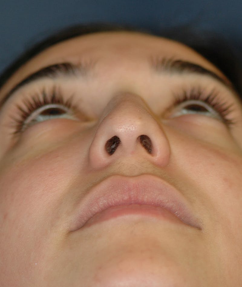 Rhinoplasty Before & After Gallery - Patient 321906 - Image 8