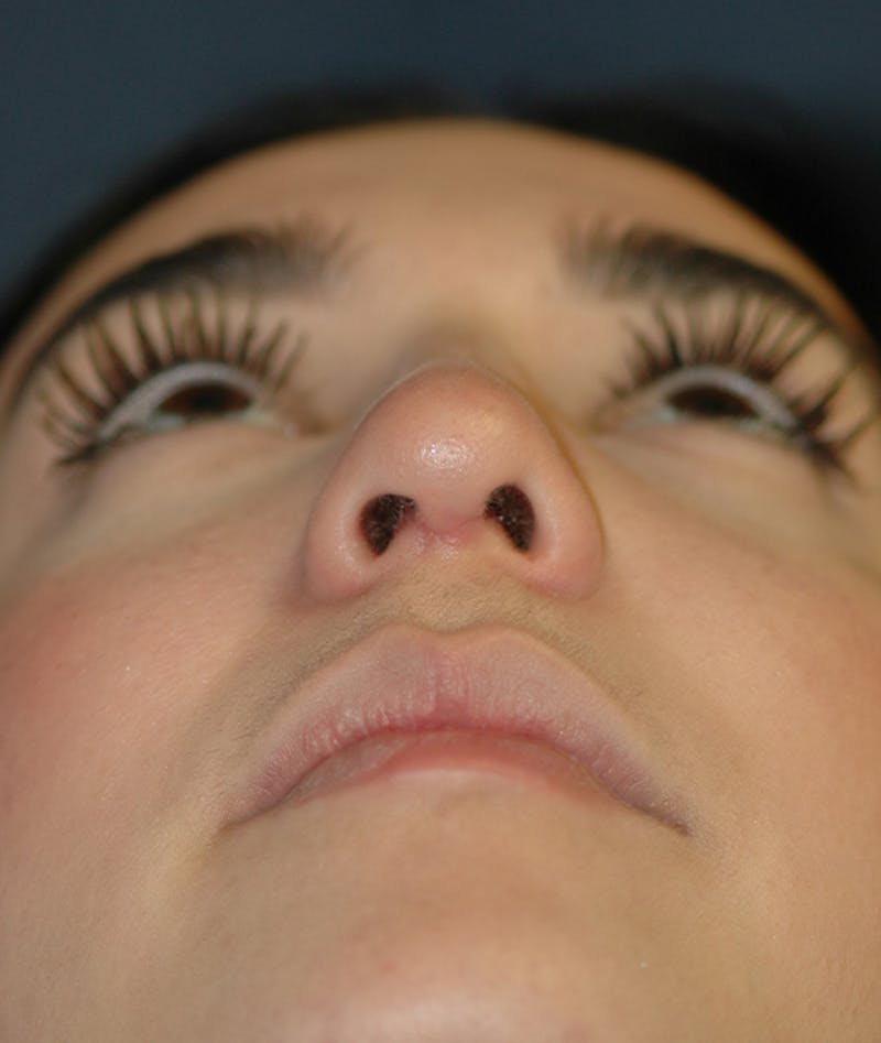 Rhinoplasty Before & After Gallery - Patient 321906 - Image 7