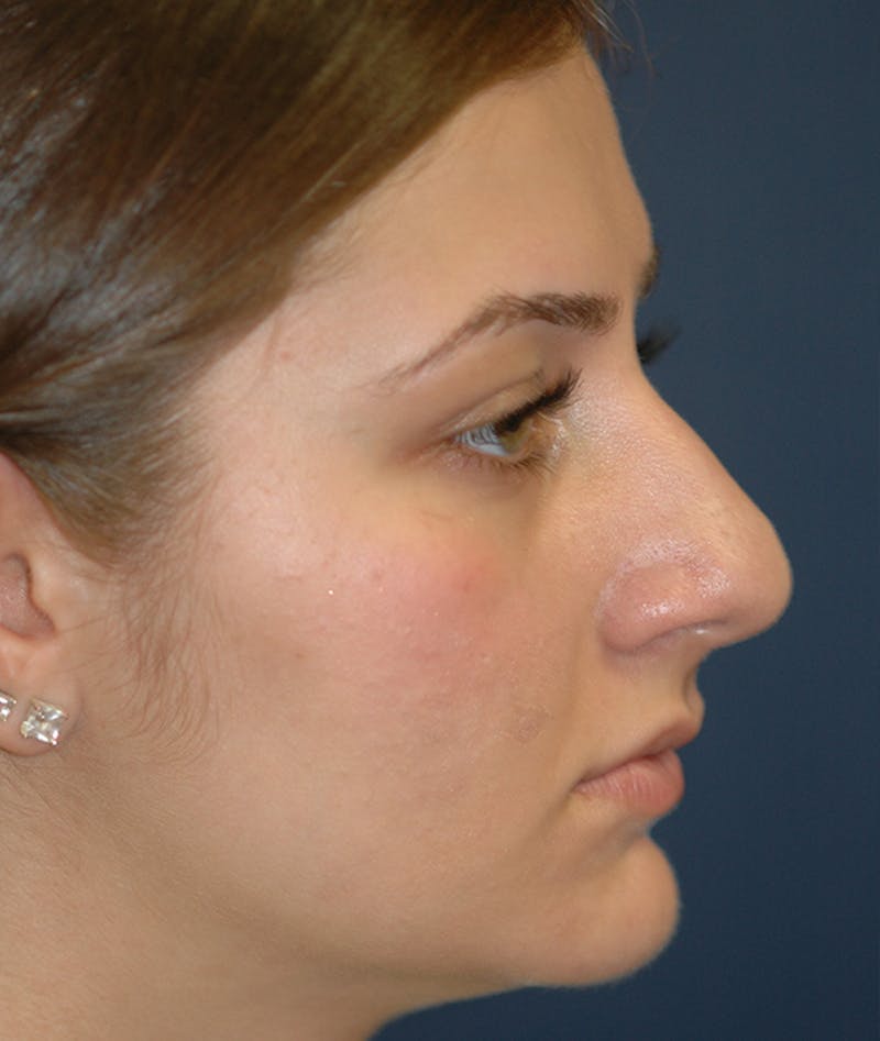 Rhinoplasty Before & After Gallery - Patient 252887 - Image 5