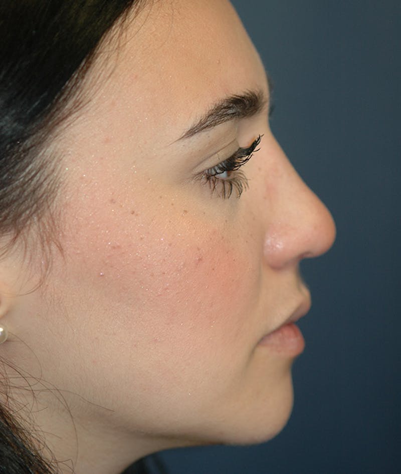 Rhinoplasty Before & After Gallery - Patient 321906 - Image 6