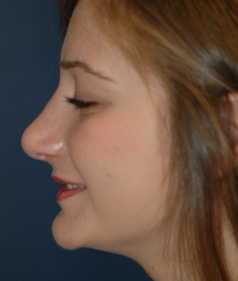 Rhinoplasty Before & After Gallery - Patient 252887 - Image 4