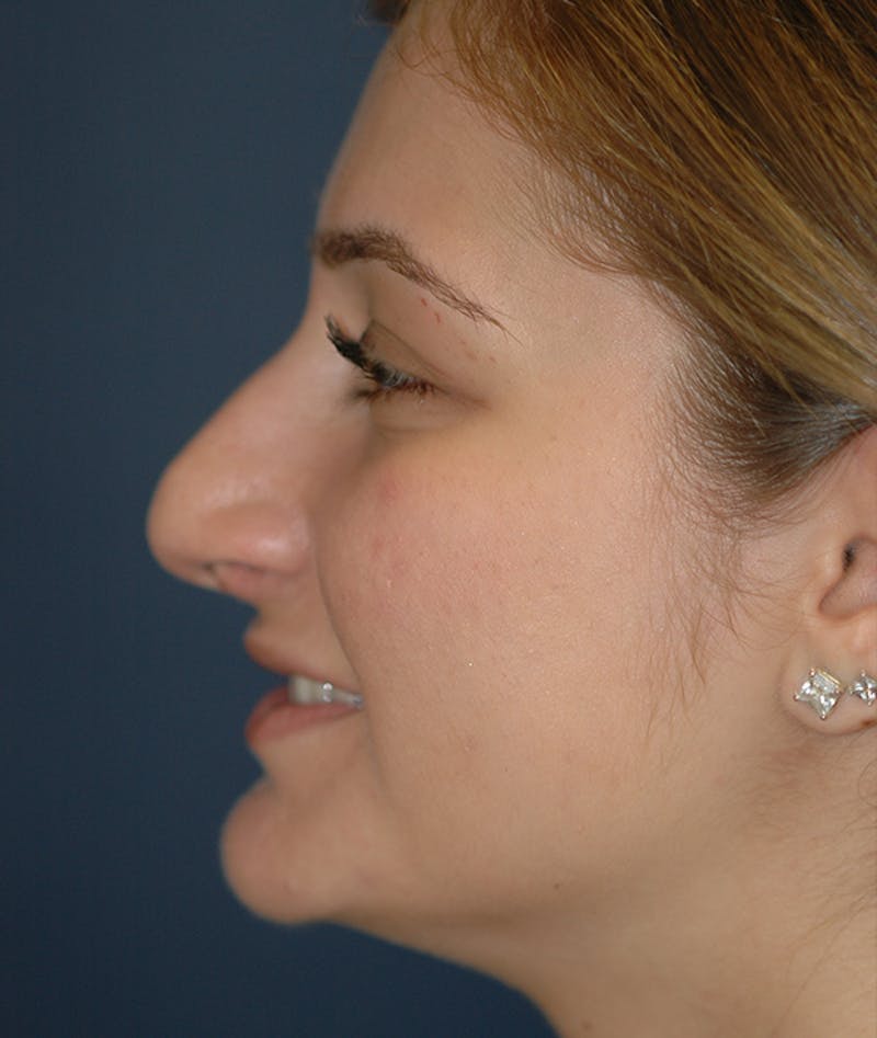 Rhinoplasty Before & After Gallery - Patient 252887 - Image 3