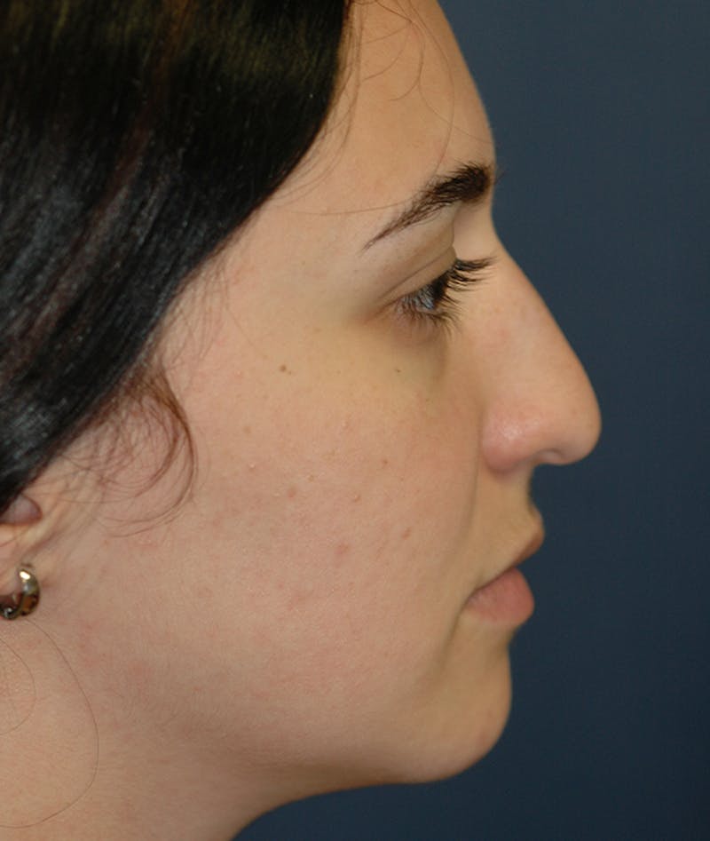 Rhinoplasty Before & After Gallery - Patient 321906 - Image 5