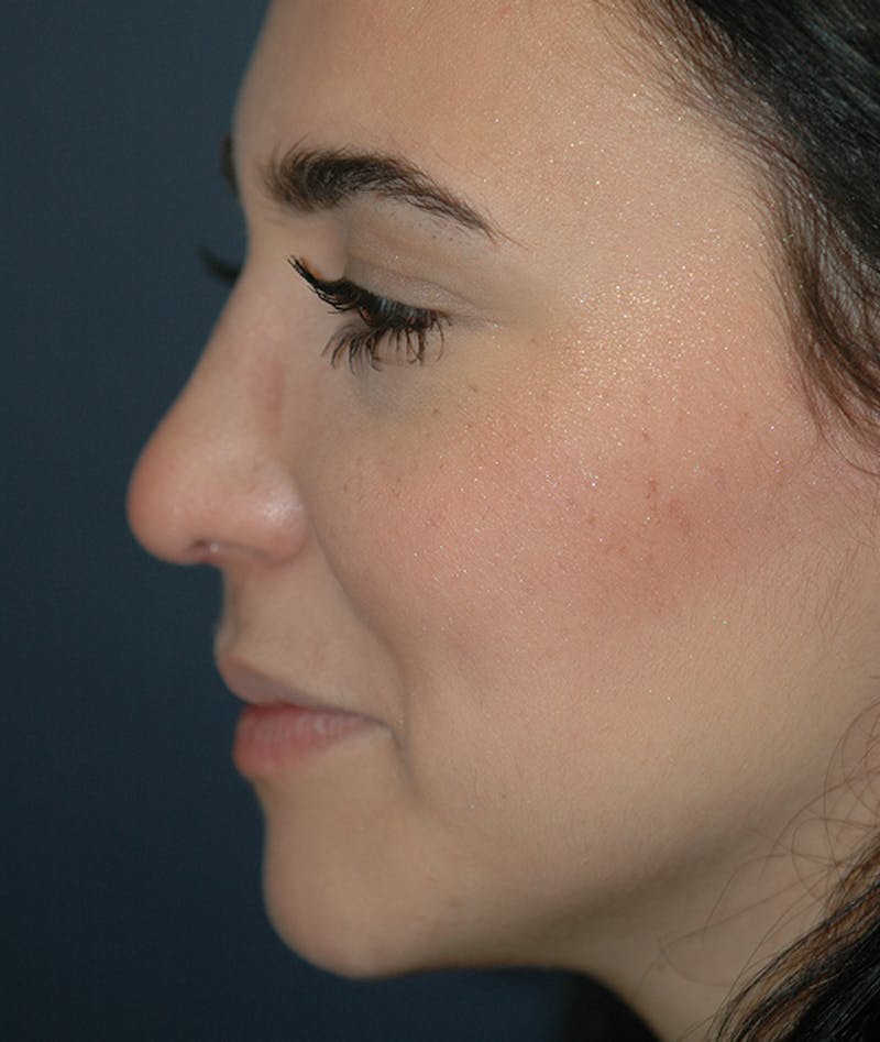 Rhinoplasty Before & After Gallery - Patient 321906 - Image 4