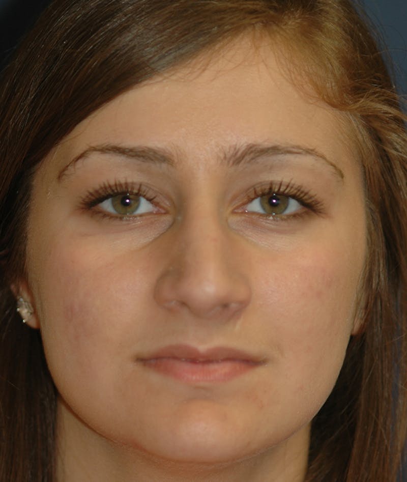 Rhinoplasty Before & After Gallery - Patient 252887 - Image 2
