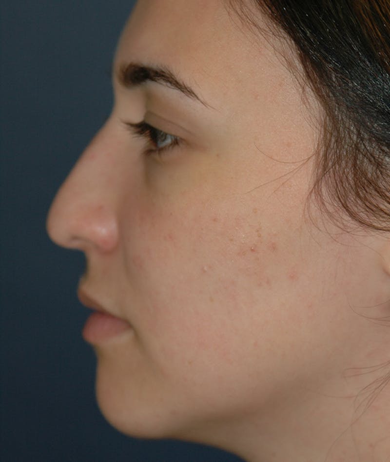 Rhinoplasty Before & After Gallery - Patient 321906 - Image 3