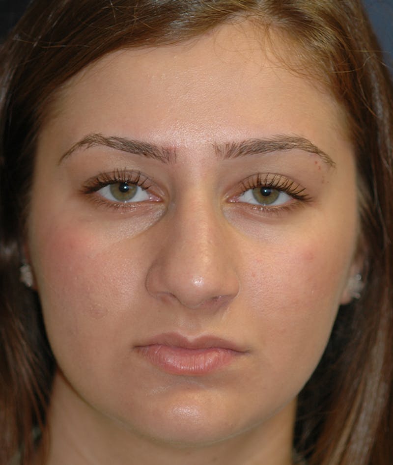 Rhinoplasty Before & After Gallery - Patient 252887 - Image 1